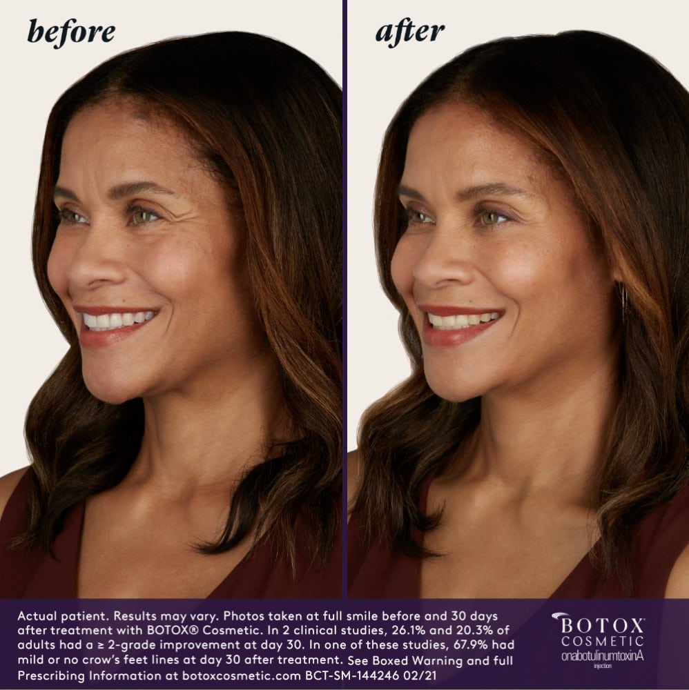 BOTOX before and after | JHR Plastic Surgery