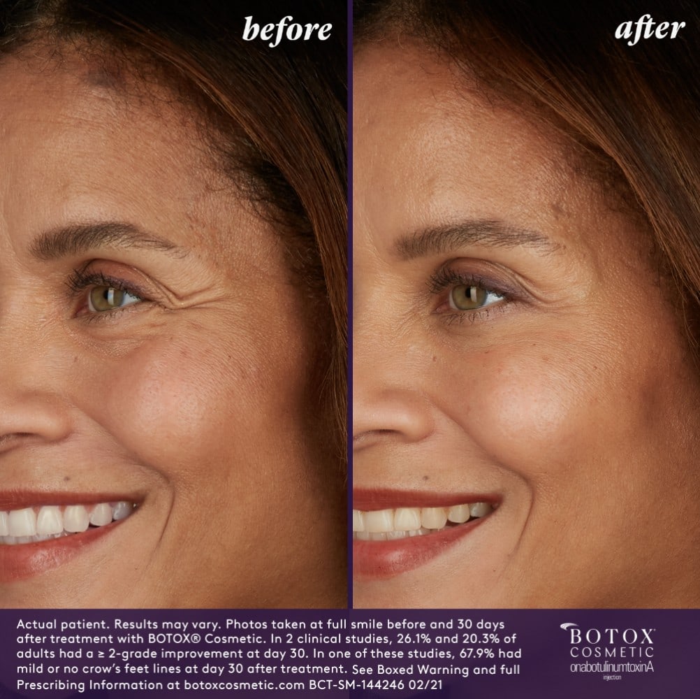 BOTOX before and after | JHR Plastic Surgery