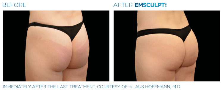 EMSCULPT NEO before and after | JHR Plastic Surgery