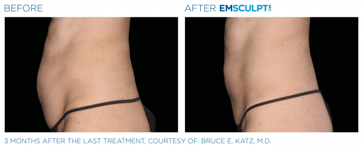 EMSCULPT NEO before and after | JHR Plastic Surgery