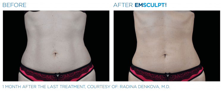 EMSCULPT NEO before and after | JHR Plastic Surgery