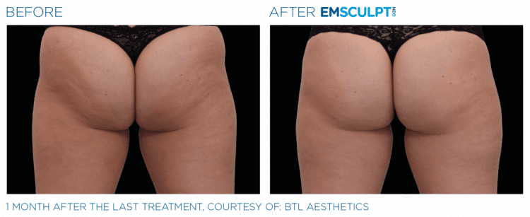 EMSCULPT NEO before and after | JHR Plastic Surgery
