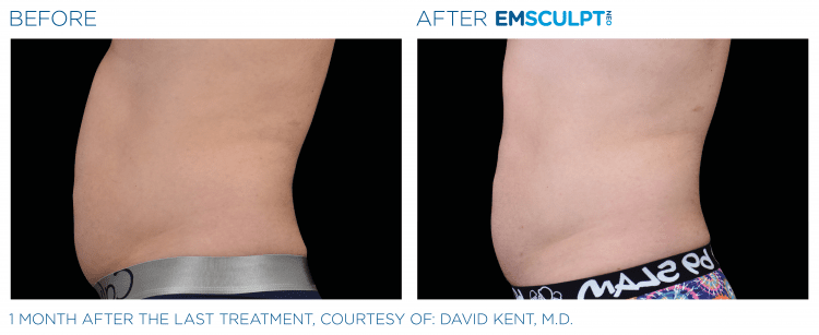 EMSCULPT NEO before and after | JHR Plastic Surgery