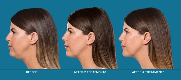 Kybella before and after | JHR Plastic Surgery