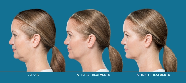 Kybella before and after | JHR Plastic Surgery