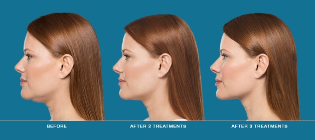 Kybella before and after | JHR Plastic Surgery