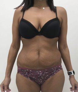 Before and After | Abdominoplasty