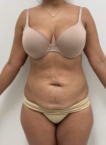 Before and After | Abdominoplasty