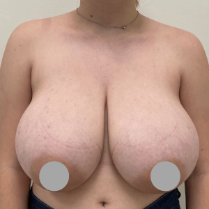 Before and After | Breast Reduction