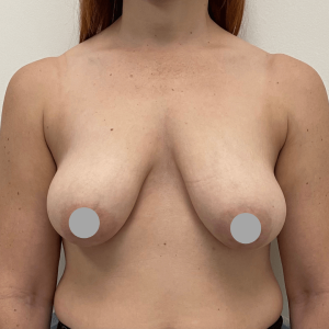 Before and After | Breast Lift