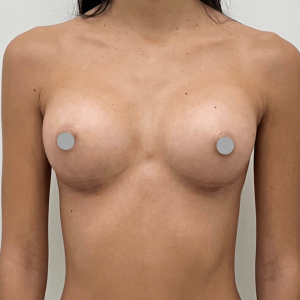 Before and After | Breast Augmentation