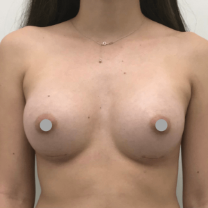 Before and After | Breast Augmentation