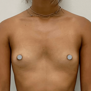 Before and After | Breast Augmentation