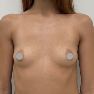 Before and After | Breast Augmentation