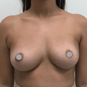 Before and After | Breast Augmentation