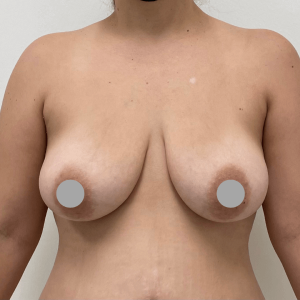 Before and After | Breast Lift