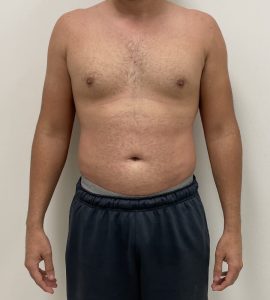Before and After | Liposuction